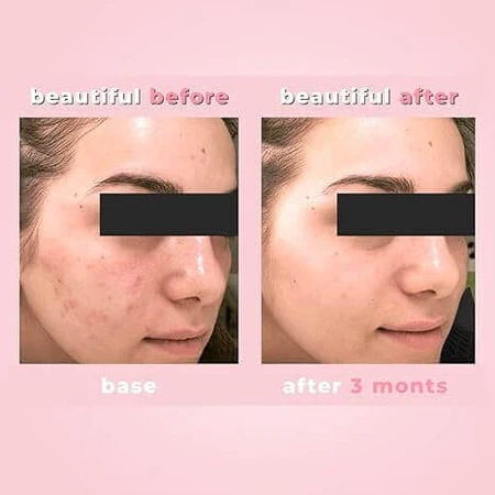 Крем Biotrade Acne Out Active для шкіри, схильної до акне, 30 мл: ціни та характеристики
