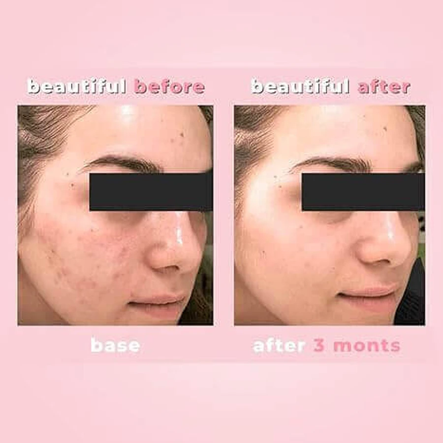 Крем Biotrade Acne Out Active для шкіри, схильної до акне, 30 мл: ціни та характеристики