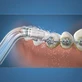 Ортодонтические насадки для рта, 2 мундштука, OD-100, Waterpik
