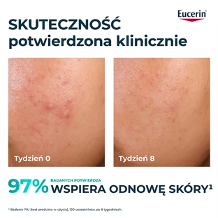 Eucerin DermoPure Clinical Peeling 10, відлущуючий і розгладжуючий засіб для шкіри, схильної до акне, 40 мл