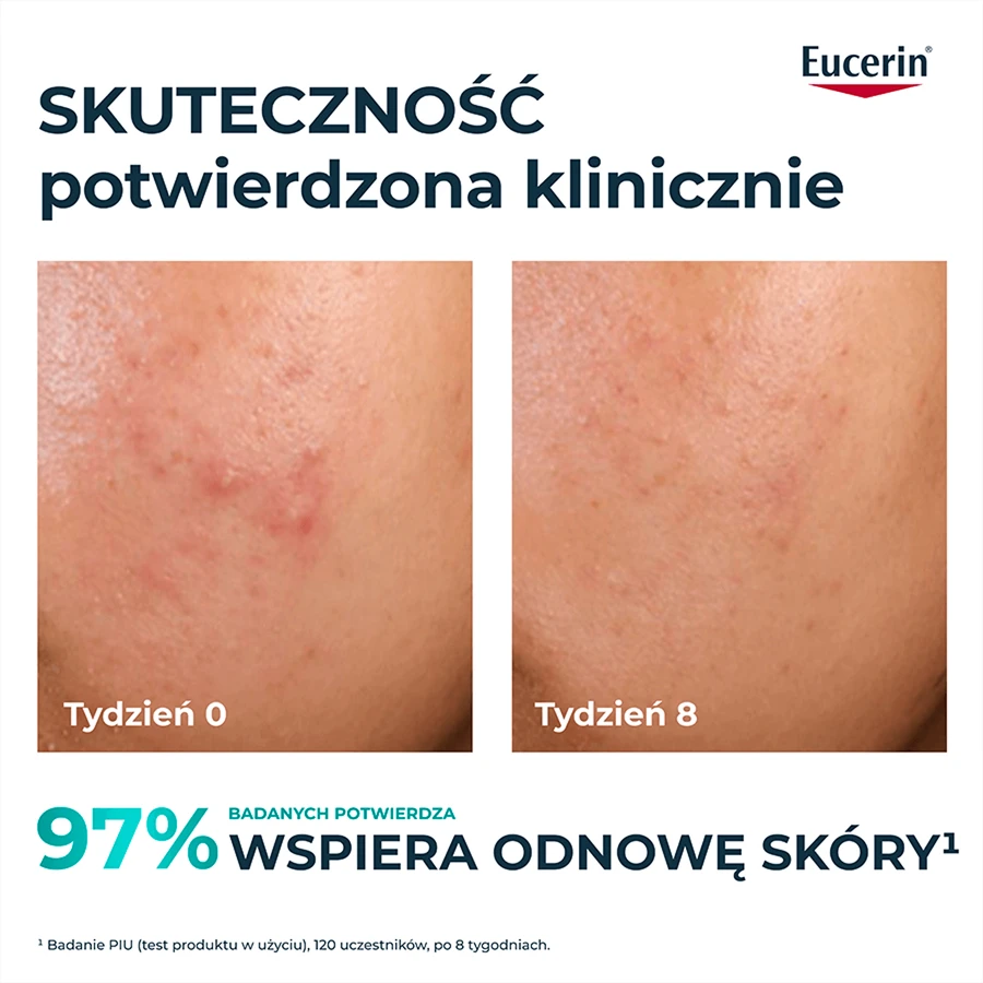 Eucerin DermoPure Clinical Peeling 10, отшелушивающее и разглаживающее средство для кожи, склонной к акне, 40 мл: цены и характеристики