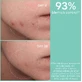 Apivita Just Bee Clear Лосьйон для обличчя та очей для шкіри, схильної до акне, 200 мл